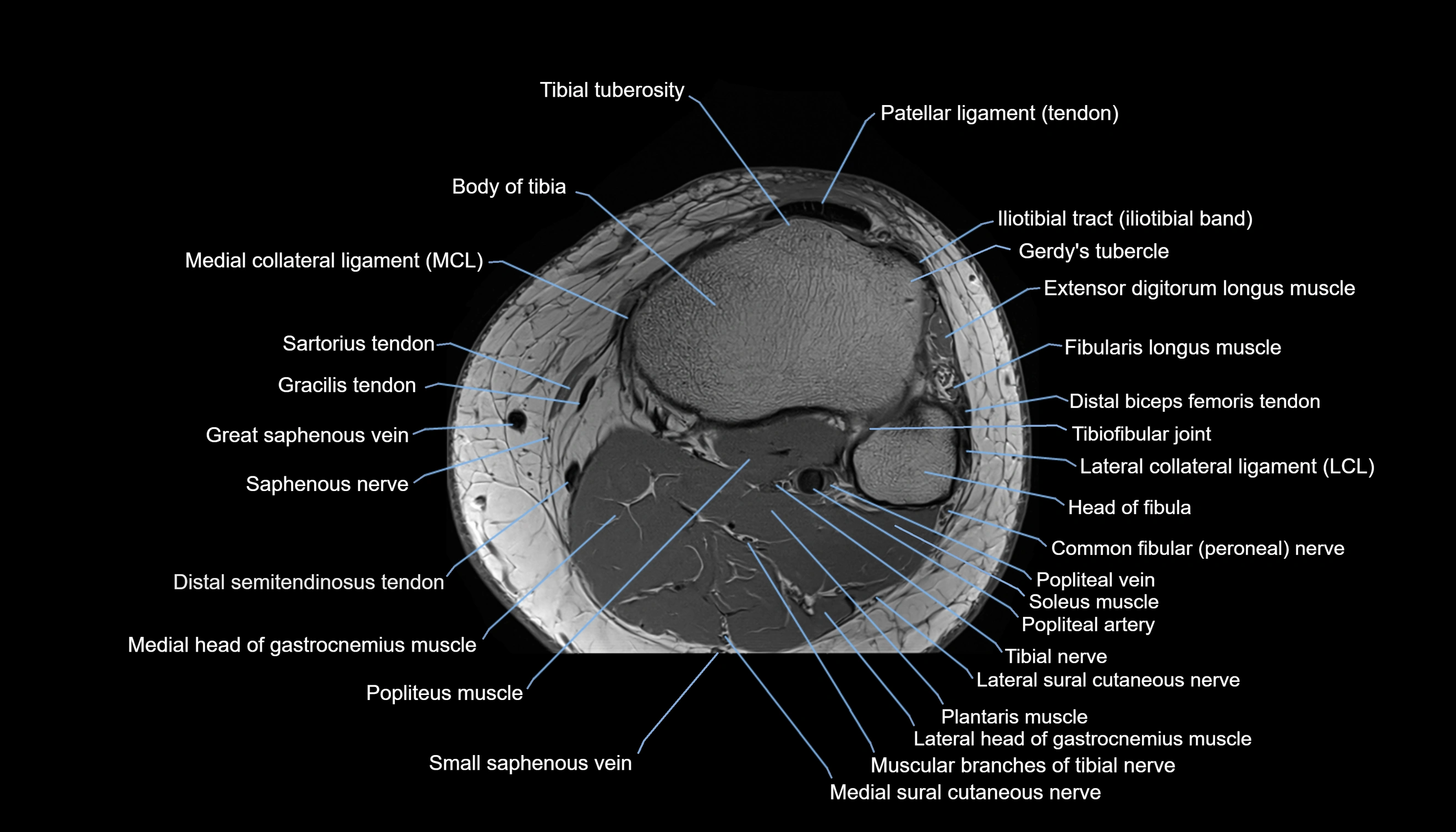 MRI knee  axial cross sectional anatomy 3T radiology  image-img-00001-00041.webp